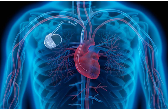 Saudi Teenager Receives state-of the-art Pacemaker